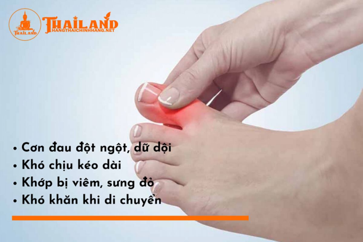 Dấu hiệu của bệnh gút