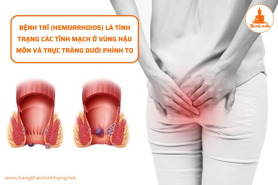Bệnh trĩ là gì
