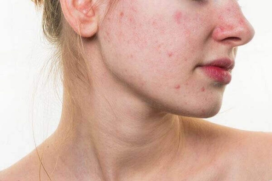 Cách phục hồi da nhiễm Corticoid