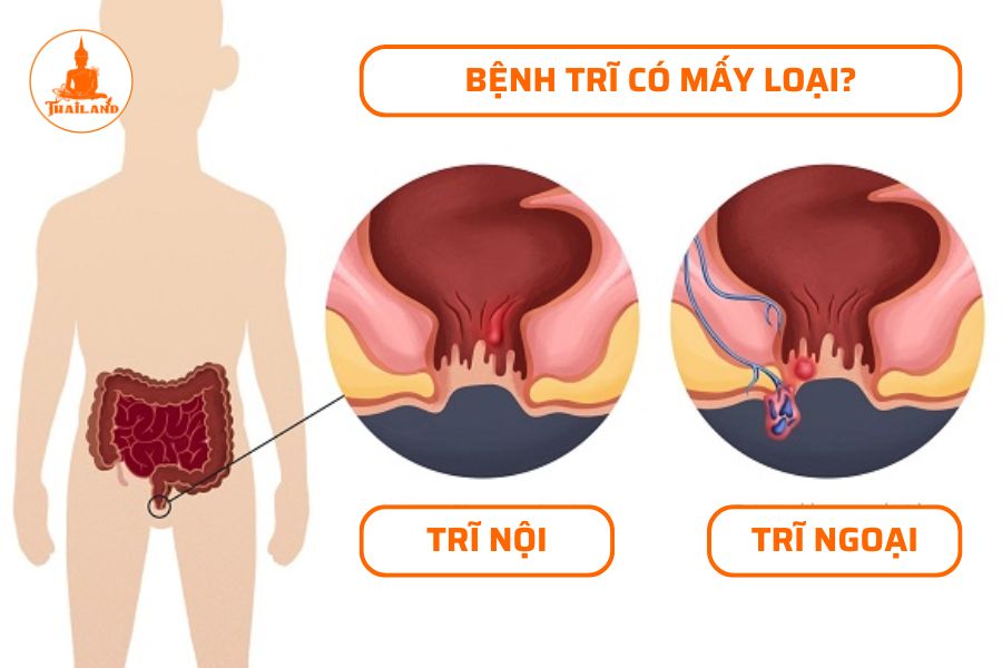 Phân loại bệnh trĩ