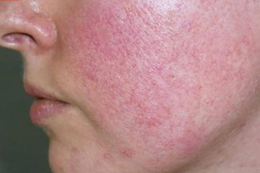 Tác hại của kem trộn