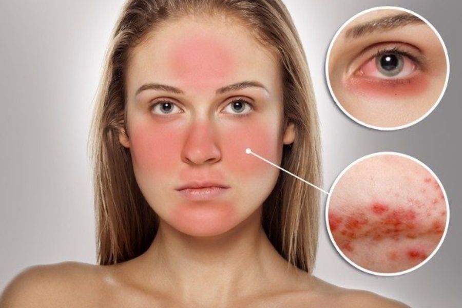 Tác hại khi sử dụng mỹ phẩm chứa Corticoid