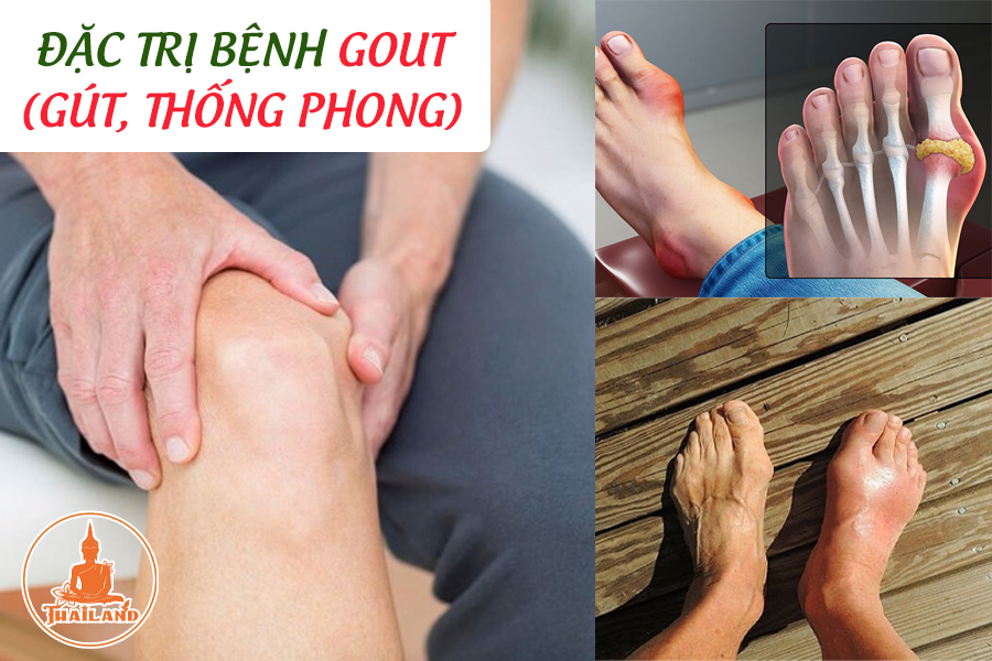 Thuốc trị bệnh gout (gút, thống phong) - Foong Cir Tan